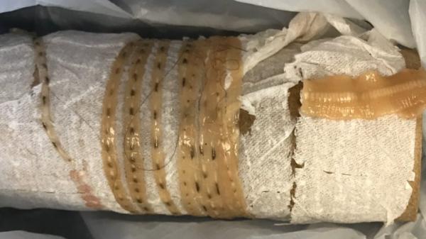 【悲報】サーモン寿司を食った男の肛門から「1.7ｍのサナダムシ」が発見されるｗｗｗｗｗ