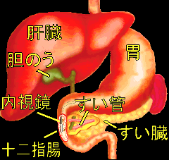 【恐怖】すい臓がんとかいう優しいところが一つもないガンw