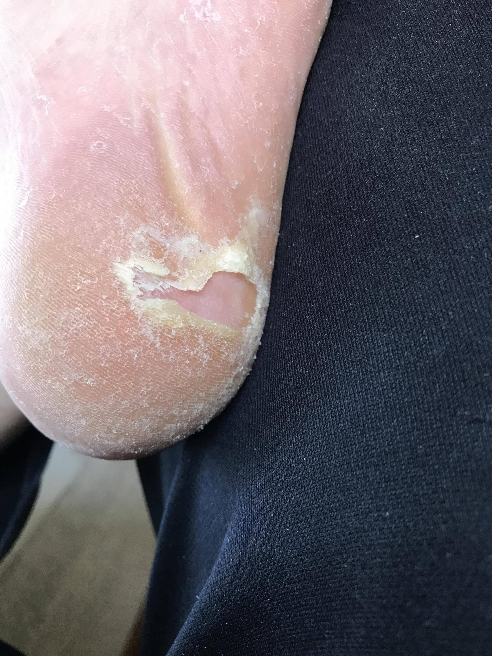 【画像】ワイのかかとがヤバイから見てくれｗｗｗｗｗｗ