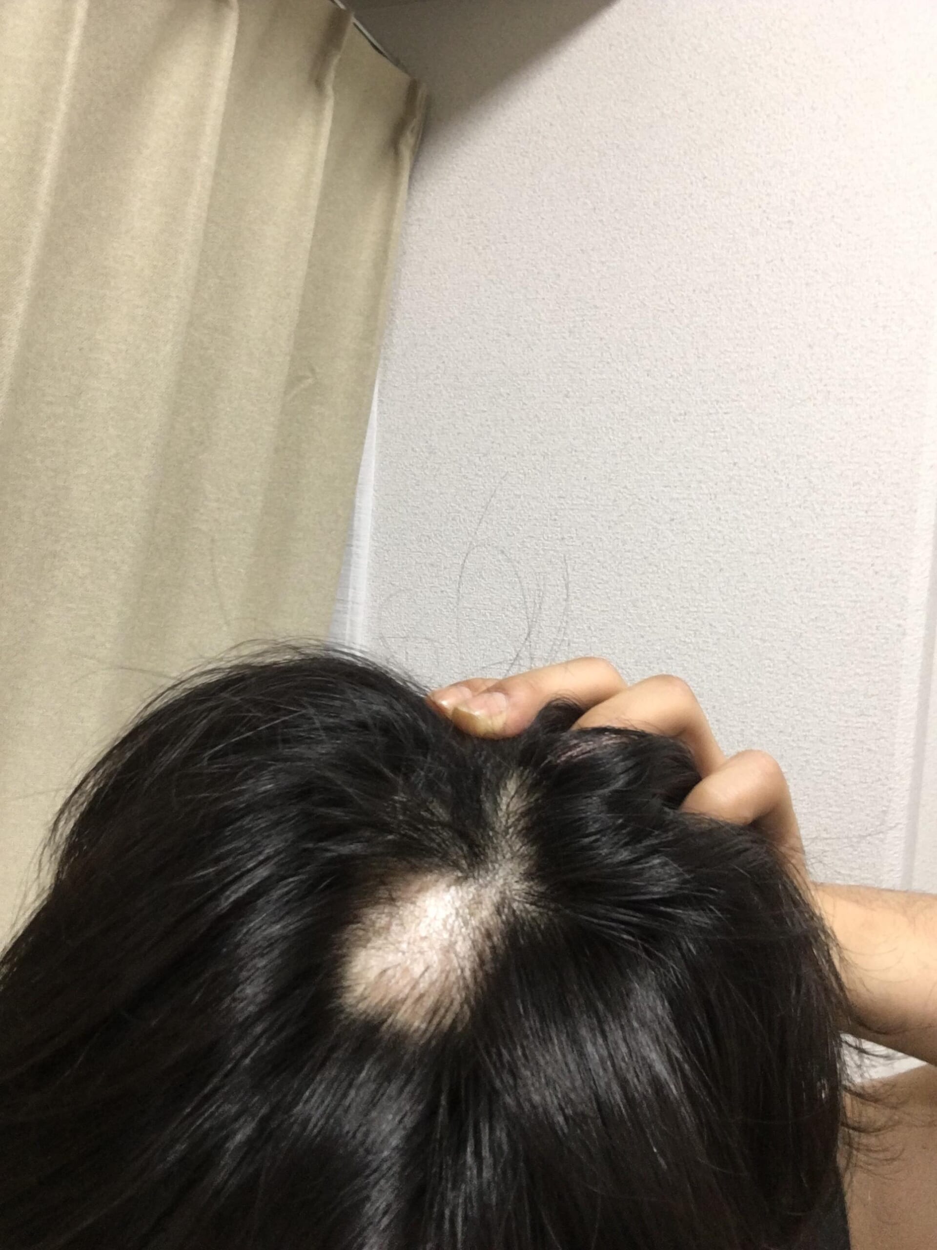 【緊急】10円ハゲに自信ニキｗｗｗｗｗ