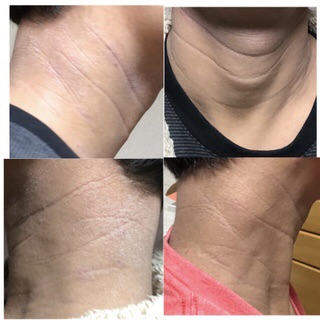 【閲覧注意】アトピーの奴って何で首にリング作ってるん？ｗｗｗｗｗｗ