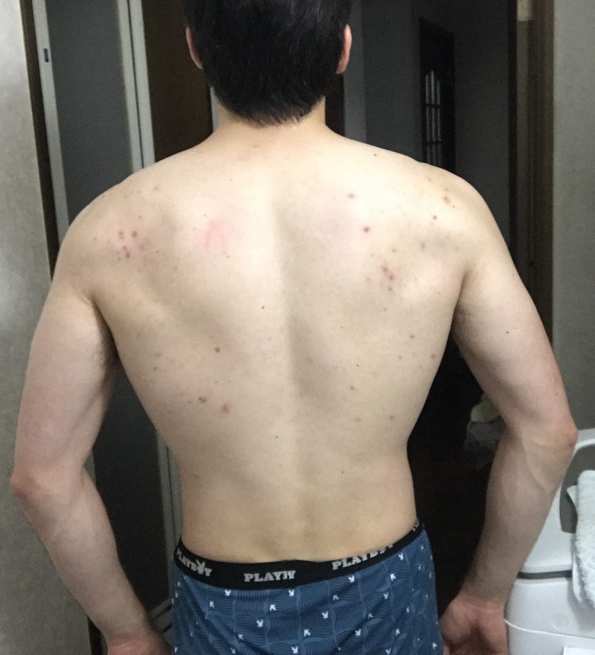 【画像】ワイの背中汚いんやが、どうしたら綺麗になる？ｗｗｗｗｗ