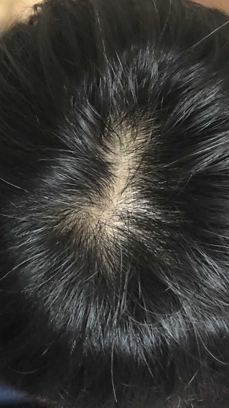 ワイの頭皮はハゲとるんか？